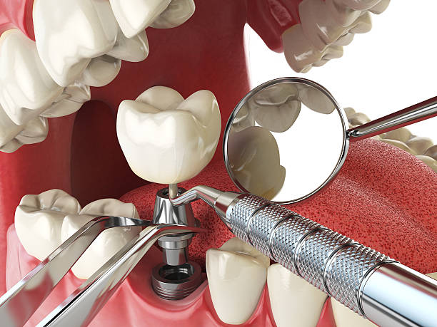 Best Emergency Tooth Extraction in Greenville, DE